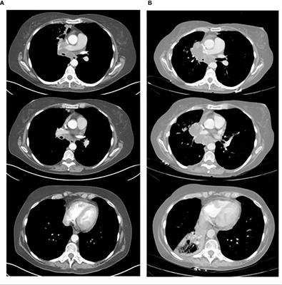 Hyperprogressive disease in non-small cell lung cancer treated with immune checkpoint inhibitor therapy, fact or myth?